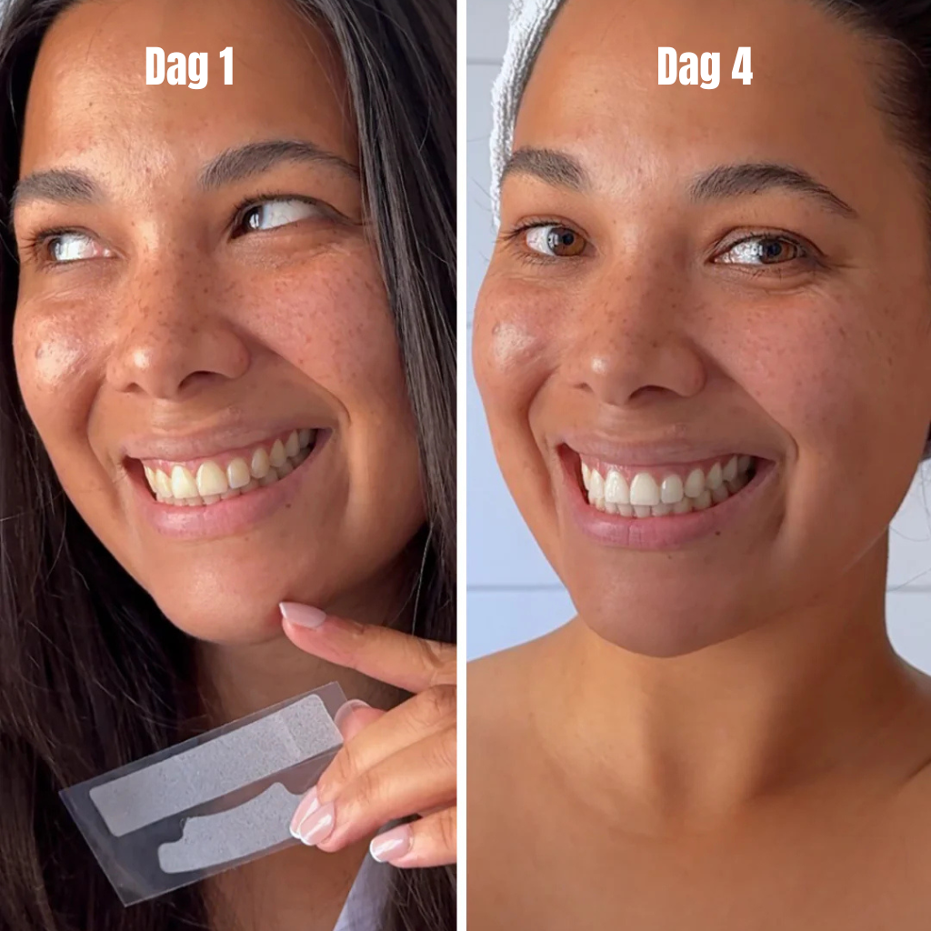 VBLS – Whitening Strips (7-daagse behandeling)